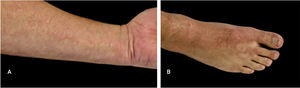 Confluent rash presented by the patient nine days after the onset of respiratory symptoms. The skin lesions persisted for three days, and the pruritus improved with the use of antihistamines. (A) Lesions on the forearm were the first to appear, with macular characteristics; (B) On the lower limbs, the lesions were maculopapular, with the formation of plaques similar to urticaria. *The photos were taken by the patient due to social isolation.