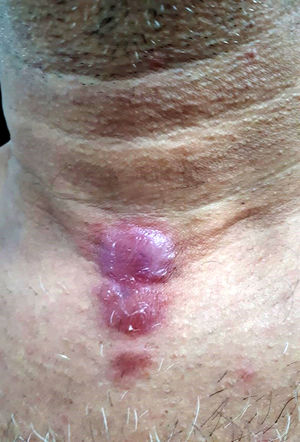 Erythematous and infiltrated plaques, confluent in the infrahyoid region, with well-defined edges.
