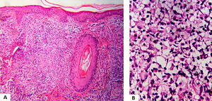 (A), Dermal granulomatous inflammatory process with epithelioid cells, giant cells and lymphocytes (Hematoxylin & eosin, ×100). (B), Dermal inflammatory process with foamy histiocytes (Hematoxylin & eosin, ×400).