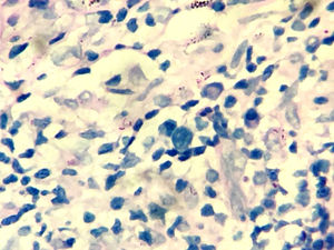 Presence of several acid-fast bacilli in the dermis (Wade, ×100).