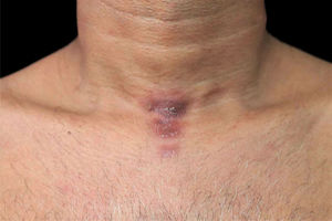 Aspect of the lesions after two months of multidrug treatment for multibacillary leprosy. The lesions are impregnated with clofazimine.