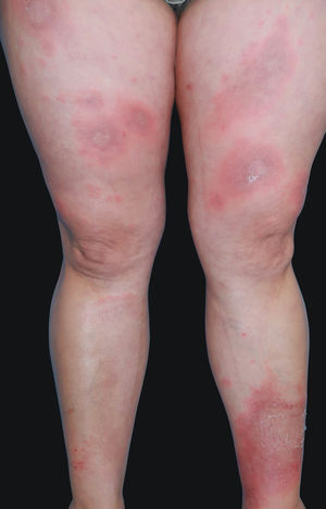 Annular erythematous plaques with trailing scale located at thighs and legs.