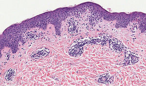 Mild spongiosis, lymphocyte exocytosis, papillary edema, and a perivascular lymphohistiocytic infiltrate in a “coat sleeve” appearance. No eosinophils were observed (Hematoxylin & eosin, ×100).