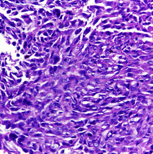 Histopathological examination showing an infiltrative neoplasm consisting of epithelioid and spindle cells with eosinophilic cytoplasm and irregular nuclei with evident nucleoli (Hematoxylin & eosin, ×400).