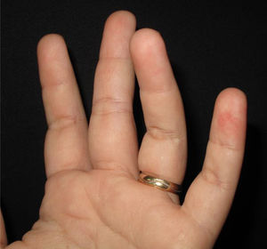 Erythematous macules on the digital pulps of the third, fourth, and fifth fingers of the left hand.
