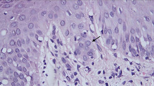 Pale nuclear inclusion (arrow) in epidermal cell amid spongiosis. Adjacent interface change with lymphocyte permeation and slight extravasation of red blood cells in the dermis (Hematoxylin & eosin, ×40).