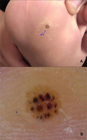 (A), Myrmecia plantar wart (arrow). (B), Plantar wart at dermoscopy, hemorrhagic dots on a yellowish background with interruption of the skin lines. Source: Dermatology Service of HC-UFMG/EBSERH.