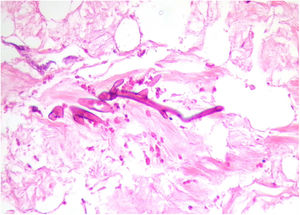 Fungal structures. Thick hyphae are highlighted with PAS stain, next to a small vessel (PAS stain, ×40).