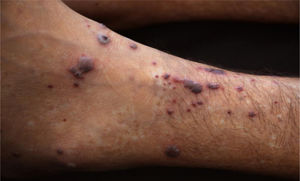 Palpable purpura and necrotic vesicles on the left lower limb.