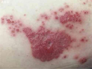 Vegetating plaque and erythematous and pinkish papules grouped in the lateral region of the right thigh.