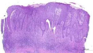 Anatomopathological examination: anastomosing epithelial cords of cuboid cells forming trabeculae in fibrous stroma that extend from the epidermis to the deep dermis (Hematoxylin & eosin, ×20).