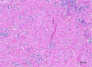 Anatomopathological examination: fibrous stroma in the middle and deep dermis (Hematoxylin & eosin, ×100).