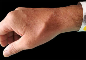 Linear subcutaneous nodule on the dorsum of the right hand.