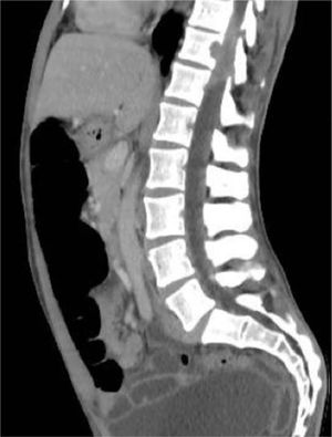 Nuclear magnetic resonance of the spine with epidural infiltration and foraminal involvement of T11 and T12, with compression and displacement of the spinal cord.