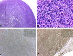 Subcutaneous nodule. (A and B), well circumscribed nodular formation formed by spindle cell bundles with minimal atypia and few mitotic figures (Hematoxylin & eosin ×100 and ×400, respectively). (C and D), SMA and H-caldesmon positive immunohistochemistry, respectively.