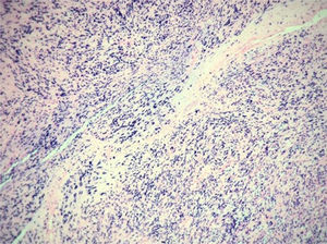 In situ hybridization study for detection of Epstein-Barr virus.