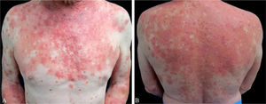 (A and B) Erythematous papules and plaques with well-demarcated areas of spared skin on anterior thorax and back.