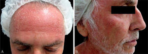 (A and B) Erythematous papules and plaques with superficial scaling on the face.