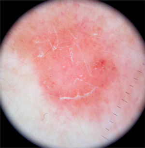 Dermoscopy shows a pink background with dotted and glomerular vessels, and fine white scaling.