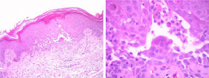 (A and B) Suprabasal acantholysis with focal spongiosis and numerous dyskeratotic cells (Hematoxylin & eosin, ×40 and ×100, respectively).