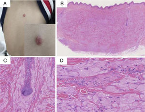 (A) A solitary, round, 3×2cm, dark-red-colored, dome-shaped, firm nodule on the back. (B) At low power, the biopsy showed aggregates and sheets of large cells with distinct cellular borders separated by thin, delicate connective tissue septa. The tumors were covered by a normal epidermis (Hematoxylin & eosin, ×40). (C) The folliculus pili were encased by the tumor (Hematoxylin & eosin, ×100). (D) The cells had abundant eosinophilic granular cytoplasm and occasional deeply eosinophilic round globules. The nuclei were vesicular, with pale chromatin and a single central nucleolus. A nerve fiber tract was also visible (Hematoxylin & eosin, ×200).