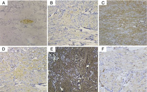 Photomicrographs of immunohistochemical studies. (A) S-100 was negative in the tumor cells, while the nerve fiber tract served as an internal positive control (Original magnification, ×200). (B) CD68, (C) vimentin, (D) Syn, and (E) NKI/C3 (CD63) were positive (Original magnification, ×100), and (F) NSE was weakly positive (Original magnification, ×200).