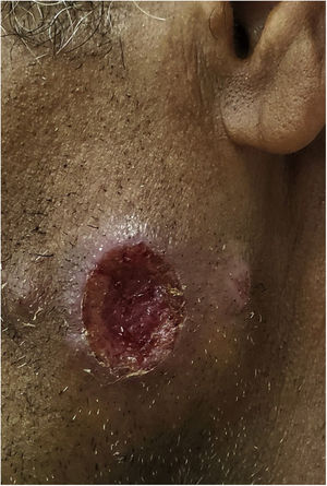 American cutaneous leishmaniasis. Facial ulcer, with an erythematous, infiltrated border and granular bottom; in a farmer from the Tietê river valley.