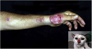 Cutaneous-lymphatic sporotrichosis, ulcer on the left hand dorsum, accompanied by ascending nodular lymphangitis in a young adult male who “adopted” an infected street animal. Picture detail showing the cat with an ulcer on the nose, a characteristic representation of feline sporotrichosis.