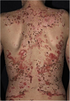 Fogo selvagem or endemic pemphigus foliaceus. Extensive exulcerations with hematic crusts on the back in a young resident of the Tietê river valley.