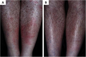 (A), Erythema chronicum migrans as the early manifestation of borreliosis-like illness. (B), Remission of clinical picture after treatment with doxycycline (Kindly provided by Prof. Sinésio Talhari).