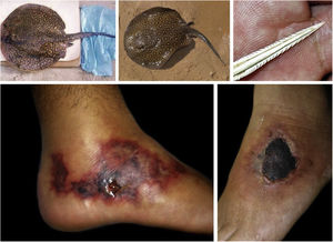 Freshwater stingrays (Potamotrygon sp.) associated with severe accidents with bathers and fishermen at the Paraná River basin. Detail of the serrated stinger. Skin lesions due to stingray accidents: lower-limb ulcers on an extensive livedoid base (< 72h) that develops into necrosis and eschar (> 7 days).