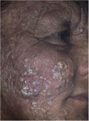 Chloracne. Farmer from the Tietê river valley with extensive papulopustular eruption with comedones. He reports unprotected handling of pesticides containing hexachlorobenzene (banned from use in Brazil in the 1980s). Three other family members were affected.