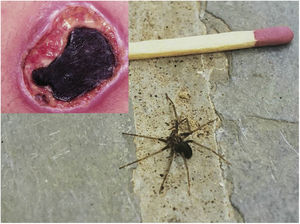 Skin ulcer with necrotic eschar formation derived from an accident caused by a spider of the genus Loxosceles (>96h). Example of an adult brown spider (Loxosceles sp.).