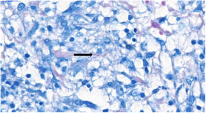 Presence of acid-alcohol-fast bacilli (AAFB; arrow) at histopathological examination of the skin (Ziehl-Neelsen, ×100).