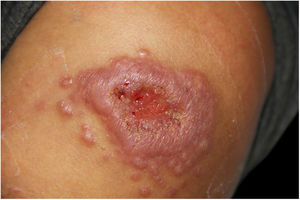 Infiltrated plaque with central ulceration surrounded by multiple satellite papules of 75 days evolution.