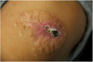 Infiltrated plaque with central sero-hematic crust after 18 months of treatment. Eleven months with itraconazole followed by seven months of terbinafine, combined with 11 sessions of cryosurgery at monthly intervals.