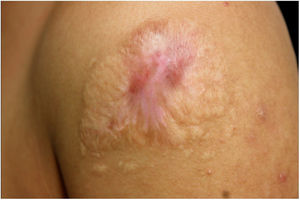 Lesion completely healed after 20 months of evolution and two months of treatment with saturated solution of potassium iodide.