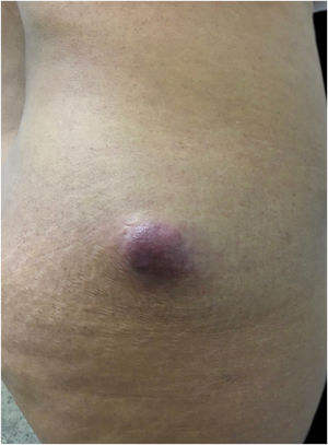Asymptomatic, hardened, erythematous tumor, of approximately 5 cm, located in the lateral region of the right gluteus.