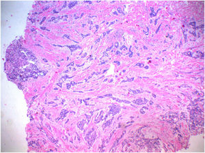 Presence, in the deep dermis, of nests and cords of cuboid cells, with eosinophilic cytoplasm, mildly pleomorphic and hyperchromatic, forming tubular structures and ductal lumens, arranged in a myxoid and collagenous stroma, compatible with adnexal skin tumor (Hematoxylin & eosin, ×40).