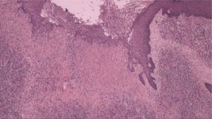 Histopathology demonstrating fibroplasia, newly formed vessels associated with an inflammatory infiltrate containing lymphocytes and neutrophils (Hematoxylin & eosin, ×40).