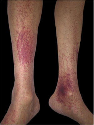 Purpuric areas in the lower limbs.