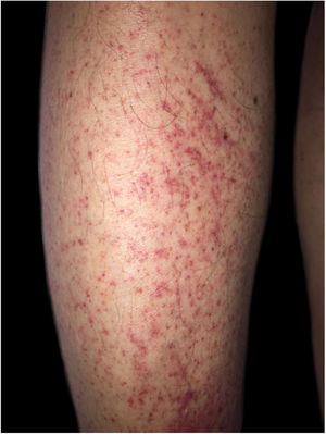 Perifollicular purpura.