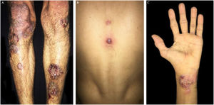 (A and C). Erythematosus nodules ulcers with violet brownish, well-defined, slightly raised borders, cribriform in the middle on legs and hands. (B) Violet papule with central vesiculation on the back dorsum.