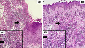 (A) Ulcer with abundant neutrophilic infiltrate on the papillary and reticular dermis. Box: detail of cellular component (arrow). (B) Dense perivascular inflammatory infiltrate of neutrophils. Box: detail of cellular component (arrow).