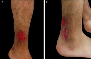 (A and B). Superficial ulcers, round in shape, well-defined, raised and slightly violet borders on both legs.