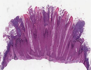 Verruca vulgaris or common wart showing hyperkeratosis, papillomatosis, acanthosis and rete ridges with their axis inclined toward the center of the lesion (Hematoxylin & eosin, 40×).