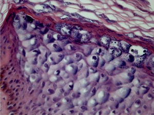 Epidermodysplasia verruciformis showing epithelial cells with clear cytoplasm and nuclear pyknosis (Hematoxylin & eosin, 400×).