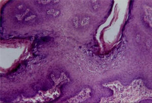 Condyloma acuminatum showing epithelial hyperplasia, papillomatosis, hypergranulosis and koilocytosis (Hematoxylin & eosin, 100×).