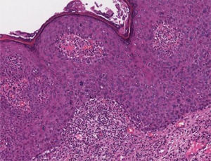Bowenoid papulosis showing acanthosis with widening and fusion of rete ridges, loss of epidermal stratification and nuclear atypia (Hematoxylin & eosin, 100×).