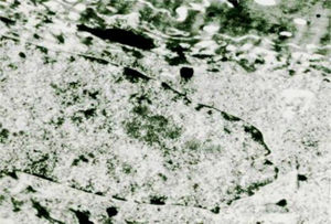 HPV electron microscopy showing intranuclear viral particles.